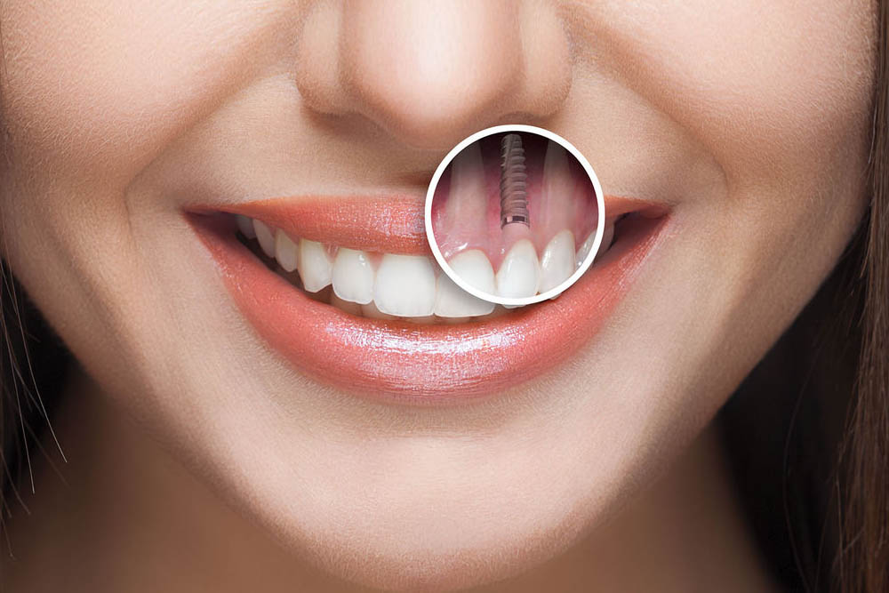 Advance Implants Surgical Procedures